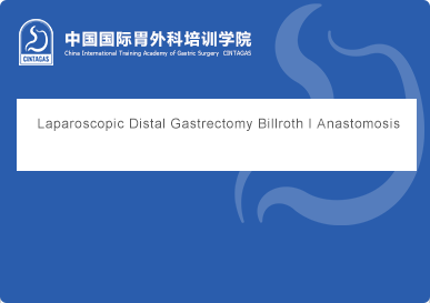 Laparoscopic Distal Gastrectomy Billroth I Overlap Anastomosis