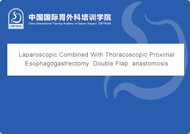 Laparoscopic Combined With Thoracoscopic Proximal Esophagogastrectomy  Double Flap  anastomosis